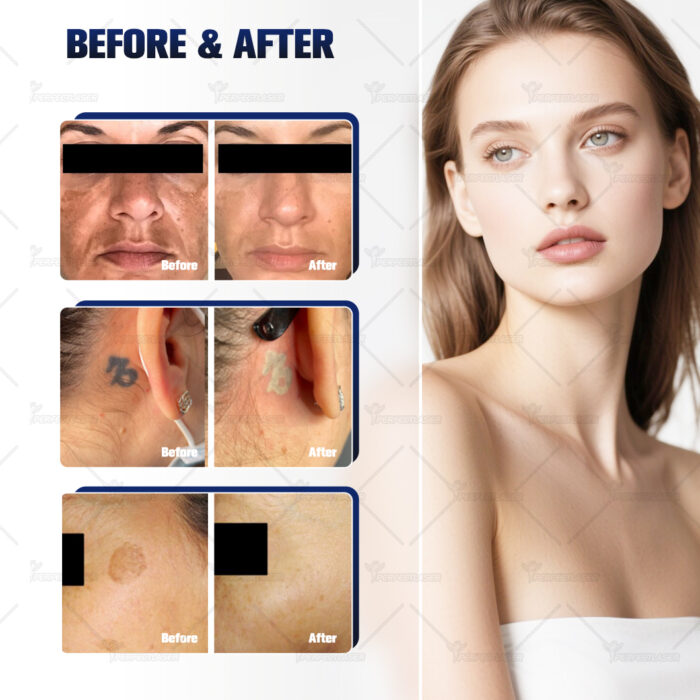 UltraPico™ Picosecond Laser Device - Image 6