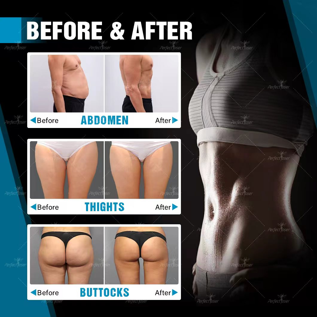 EMS Slimming Machine - Image 6